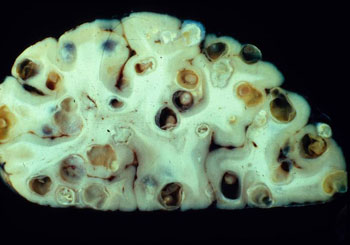 Taenia solium cysty w ludzkim mózgu <br> (Zdjęcie : Dr. Theodore Nash, National Institutes of Health, U.S.A.)